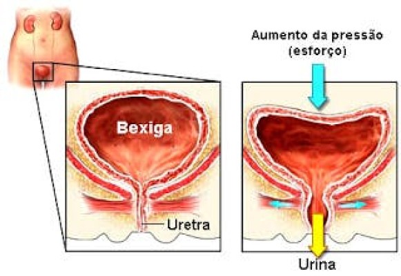 INCONTINÊNCIA URINÁRIA